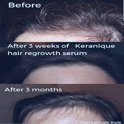 See the Keranique hair Regrowth Success after 3 Months